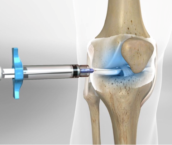 Do Ácido Hialurônico aos Hidrogéis: o que mudou nas infiltrações articulares e quando indicar cada opção